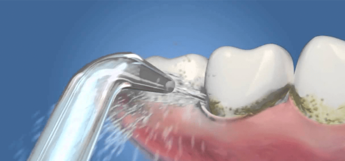 IRRIGADOR DENTAL